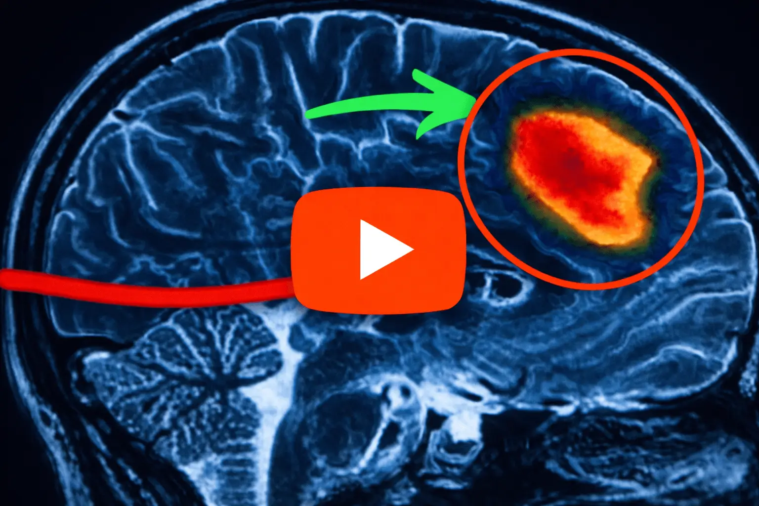 Brain scan illustrating tinnitus treatment